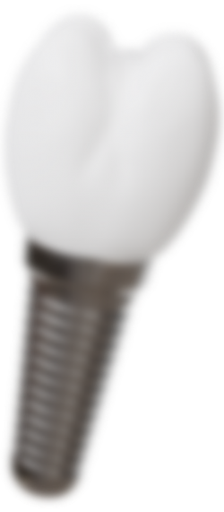 dental implant-2@2x